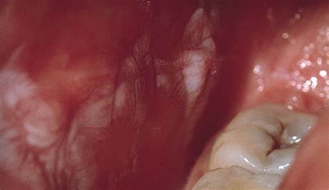 Discoid Lupus Erythematosus–Like Lesions and Stomatitis | Dermatology | JAMA Dermatology | JAMA ...