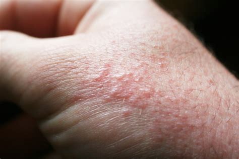 5 Common Summer Rashes and How to Prevent Them | Institute of Living | Hartford HealthCare | CT