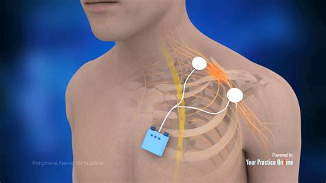 Peripheral Nerve Stimulation Video | Medical Video Library