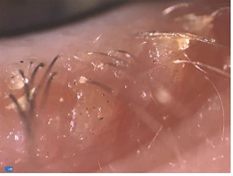 Demodex infestation: Diagnosis and management - Insight