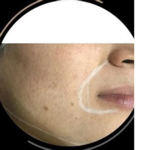 Acne Scar Removal Before and after Images – Science of Skin