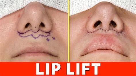 Lip Lift o Lifting de Labio en Argentina - Esteticas.com.ar