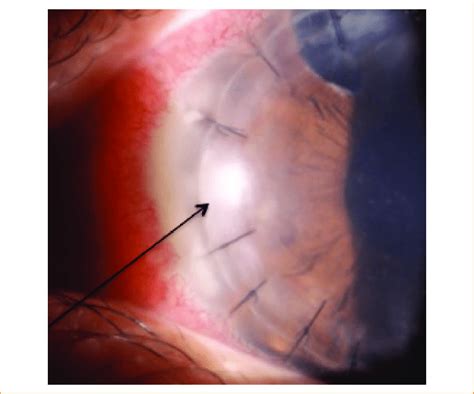 The arrow shows the initial corneal infiltrate. | Download Scientific ...