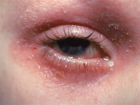 Eyelid Eczema (Eyelid Dermatitis): Symptoms, Causes, And, 49% OFF
