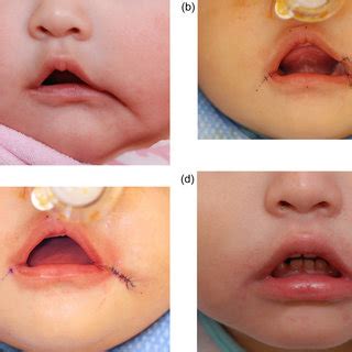 Case example. (a) Active lip depression preoperation; (b) Lip markings;... | Download Scientific ...