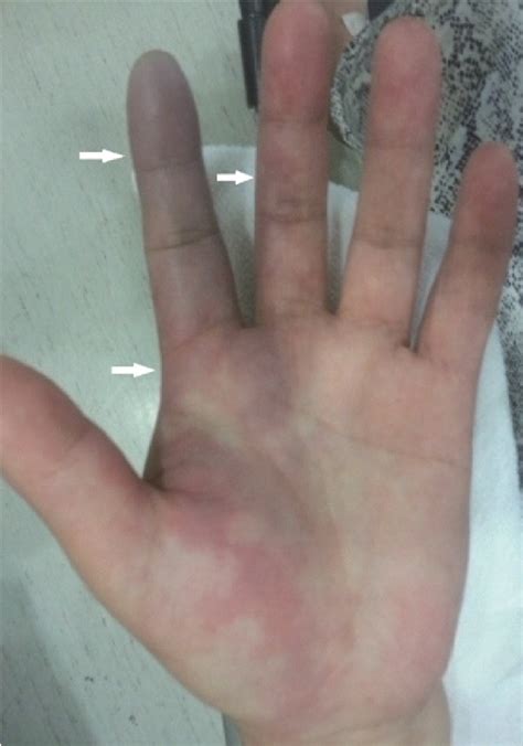 Figure 1 from Finger necrosis after accidental radial artery puncture | Semantic Scholar