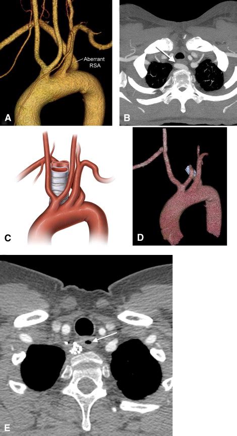 Novel approaches for the treatment of the aberrant right subclavian ...