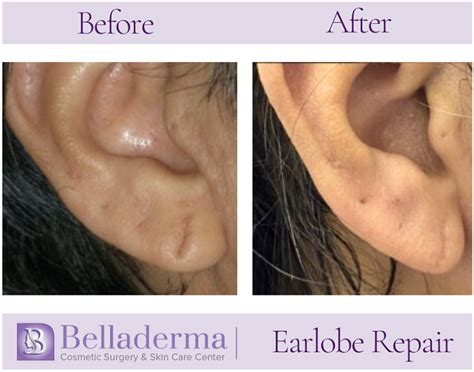 Earlobe Repair Before and After Pictures Gallery San Diego, CA