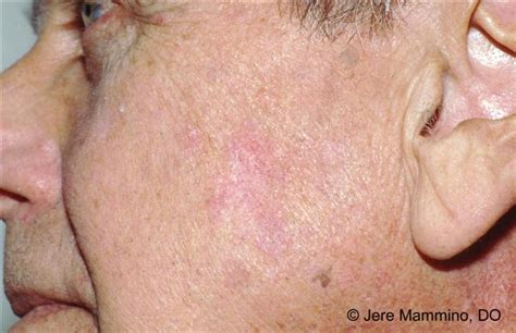 Actinic Keratosis Pictures Face