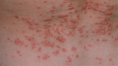 What Is Scabies? Symptoms, Causes, Diagnosis, Treatment, And Prevention ...