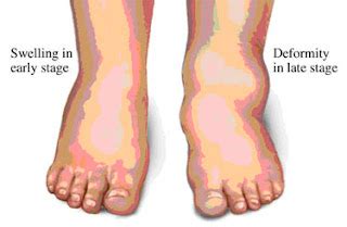 What Is Neuropathy: Diabetic peripheral neuropathy