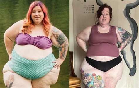 Lipedema Surgery Before And After Story - Cara's Fight For Care