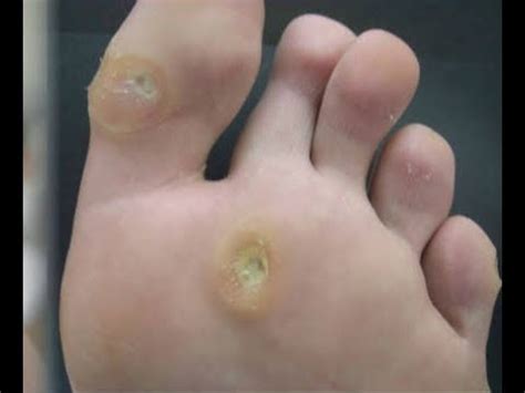 Foot Psoriasis Pain -_ The Home Treatment Guide_ - YouTube