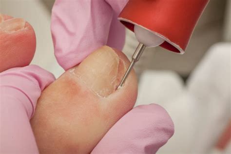 What You Need to Know About Ingrown Toenail Surgery? – Maintain proper health to live happy life ...