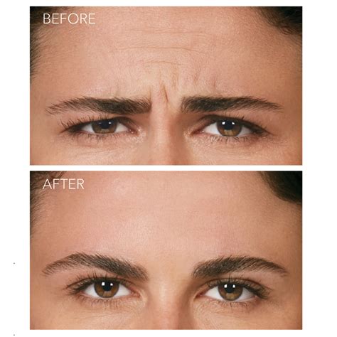 Botox Frown Lines Before And After