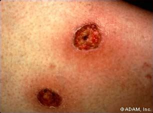 The New York Times > Health > Image > Ecthyma Gangrenosum