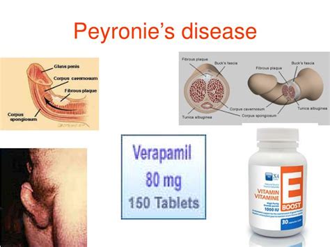 Peyronie Disease Images