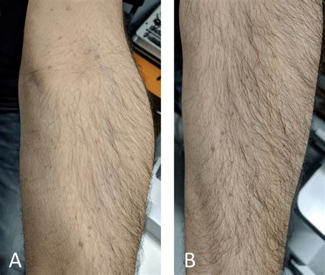 Purpuric rash. A. Over the flexor surfaces of the upper extremities; B.... | Download Scientific ...