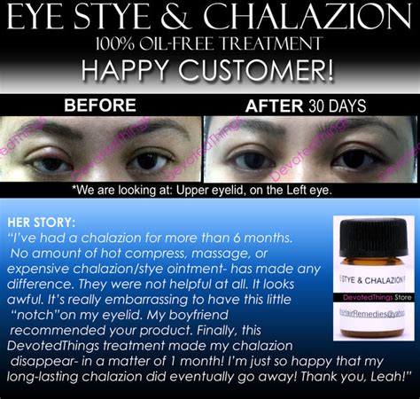 BEST Eye Stye Treatment and Chalazion Treatment 2 IN 1 Product Oil-Free | DevotedThings