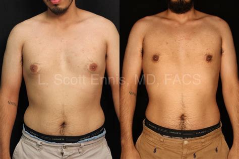 Liposuction Before And After Men