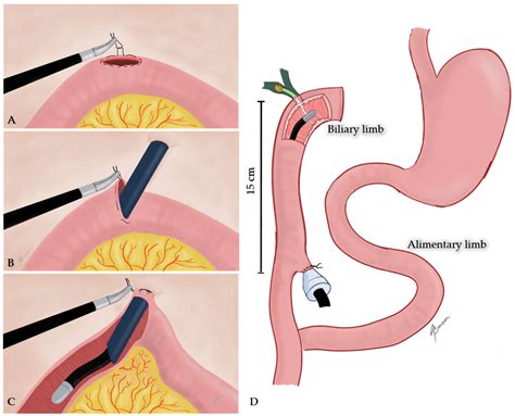 Roux En Y Hepaticojejunostomy