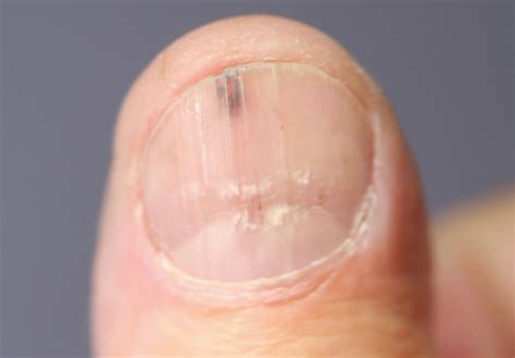 early stage nail cancer pictures | Symptoms and pictures