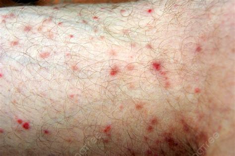 Rash On Skin Of The Leg Of The Person Background Rash On Skin Of The ...