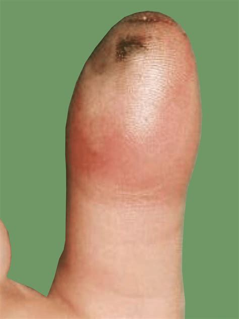 Felon – Infection of the Fingertip Pulp – Fife Virtual Hand Clinic