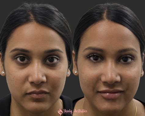 Under Eye Fillers - Before & After Results at Skinly