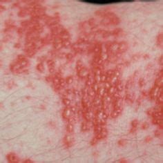 Common Skin Rashes