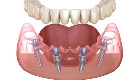 Low Cost All on 4 Dental Implants | All on 4 Dental Implants Near Me