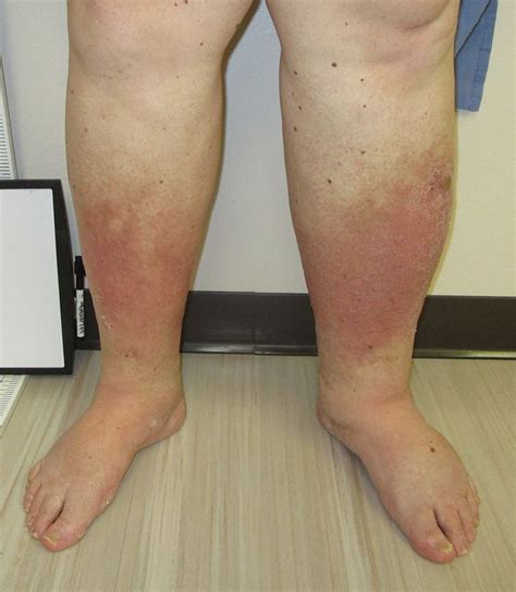 Does Venous Insufficiency Cause Pain