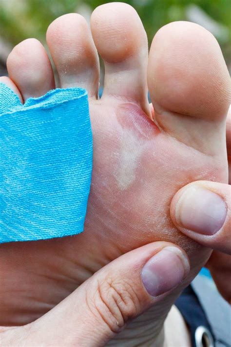 Should you pop a blister? When to do it, safe methods, and tips