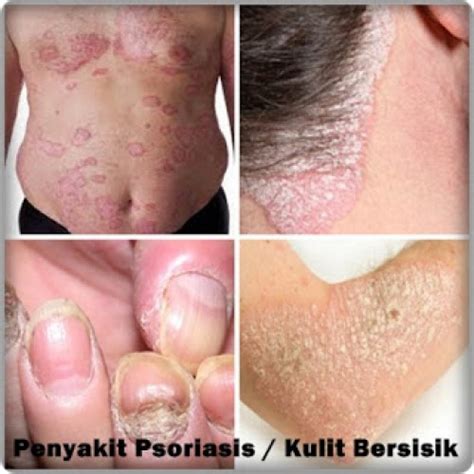 Detail Gambar Penyakit Kulit Psoriasis Koleksi Nomer 3