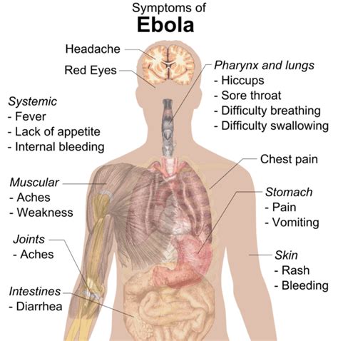 Signs and Symptoms of Ebola Virus Disease