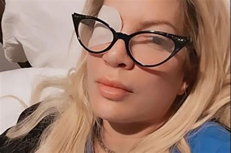 Tori Spelling gets eye ulcer after wearing contact…