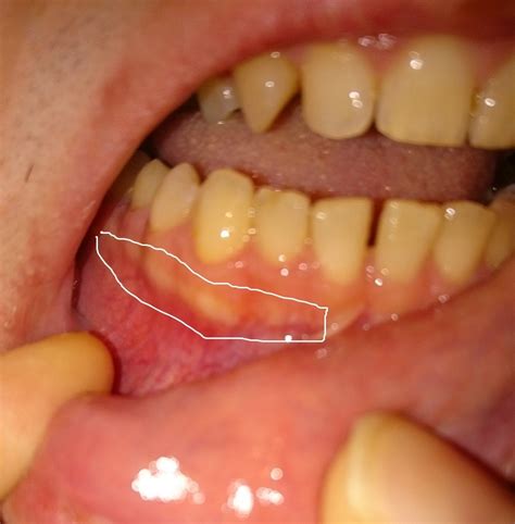 Strange white line on gums : Dentistry