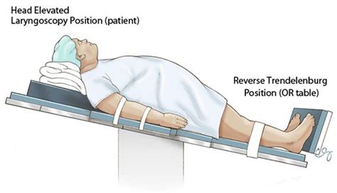 reverse trendelenburg position