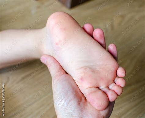 Enterovirus Feet Rash on the body of a child. Cocksackie virus rash ...