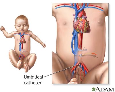 Umbilical catheters - UF Health