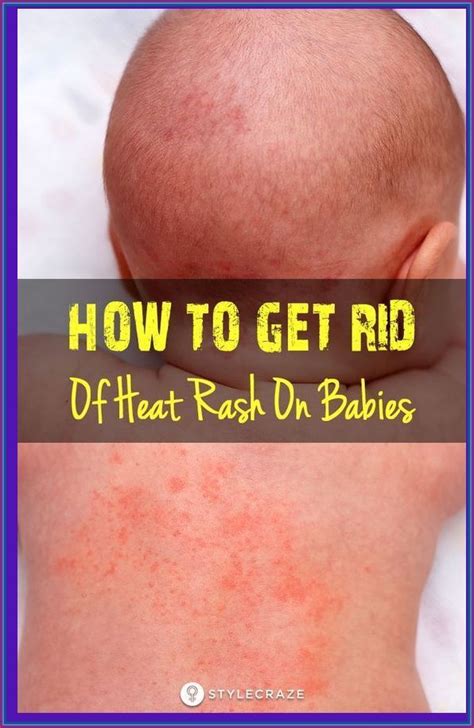 How To Get Rid Of Heat Rash On Bab | Baby heat rash, Heat rash, Baby rash