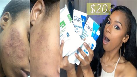 CeraVe Acne Foaming Cream Cleanser 30day Review | CeraVe Products ...