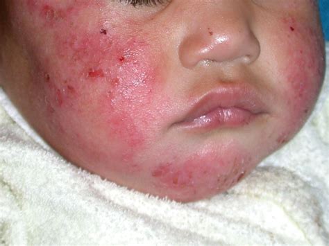 Atopic Dermatitis Face Treatment - Doctor Heck