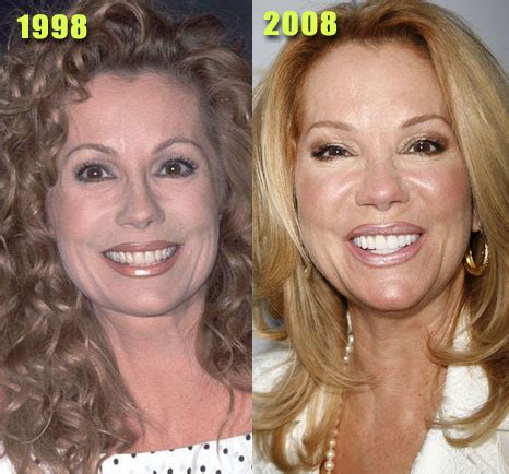 Kathie Lee Gifford Plastic Surgery Before and After Nose Job and Botox Injections