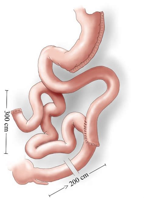 Sleeve gastrectomy with jejunal bypass. A gastric tube is created ...