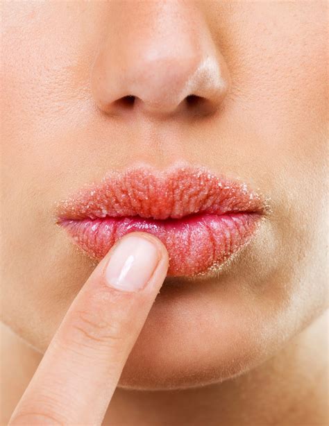 MyBodyMyLife: 100% Natural Treatment for Chapped Lips