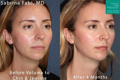 Juvéderm Voluma Dermal Filler | San Diego, CA | CLDerm