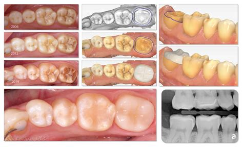 Amelogenesis Imperfecta Progression and Digital Solution - Digital Enamel