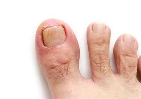 Ingrown Toenails Melbourne | Taylors Lakes | Podiatry Melbourne ...