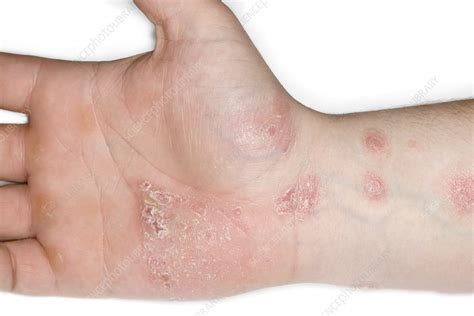 Psoriasis of the hand - Stock Image - C023/4343 - Science Photo Library